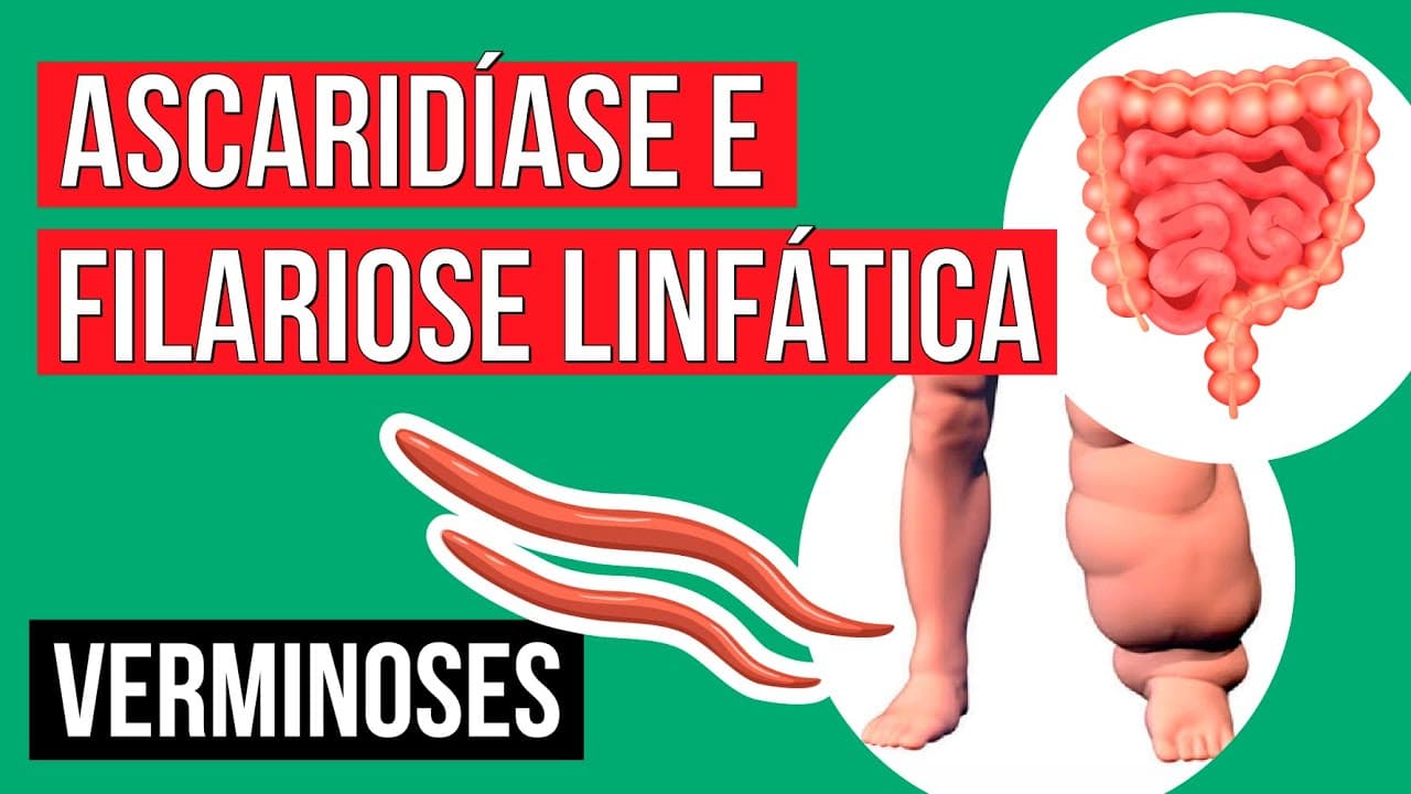 Thumbnail: Lombrigas e Elefantíase: tipos de verminoses | Resumo de Biologia para o Enem | Cláudia