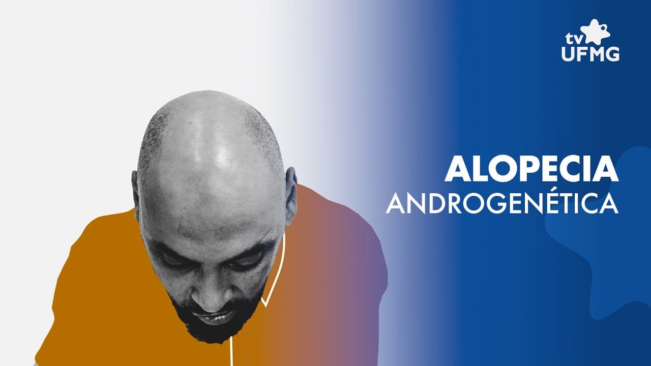 Thumbnail: Alopecia androgenética: pesquisadoras da UFMG explicam como a calvície atua na estrutura capilar