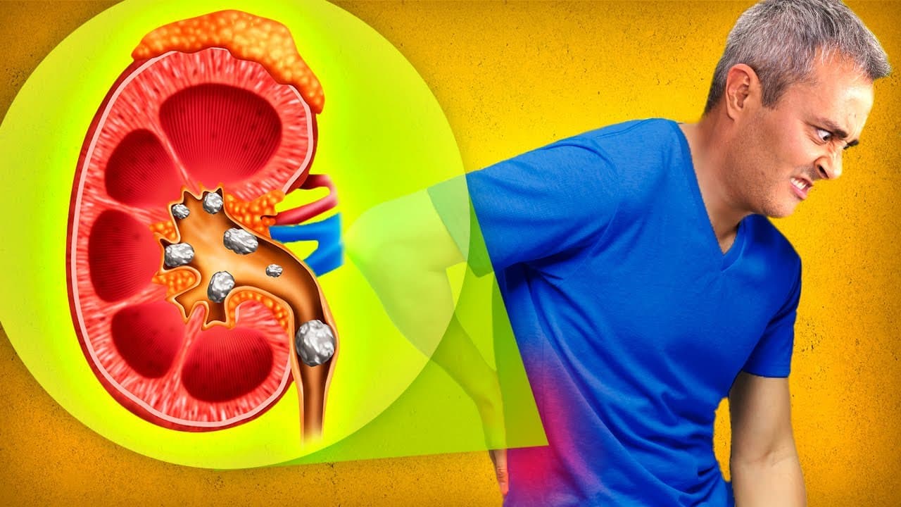 Thumbnail: TIVE PEDRAS NO RIM! A pior dor que um ser humano pode sentir